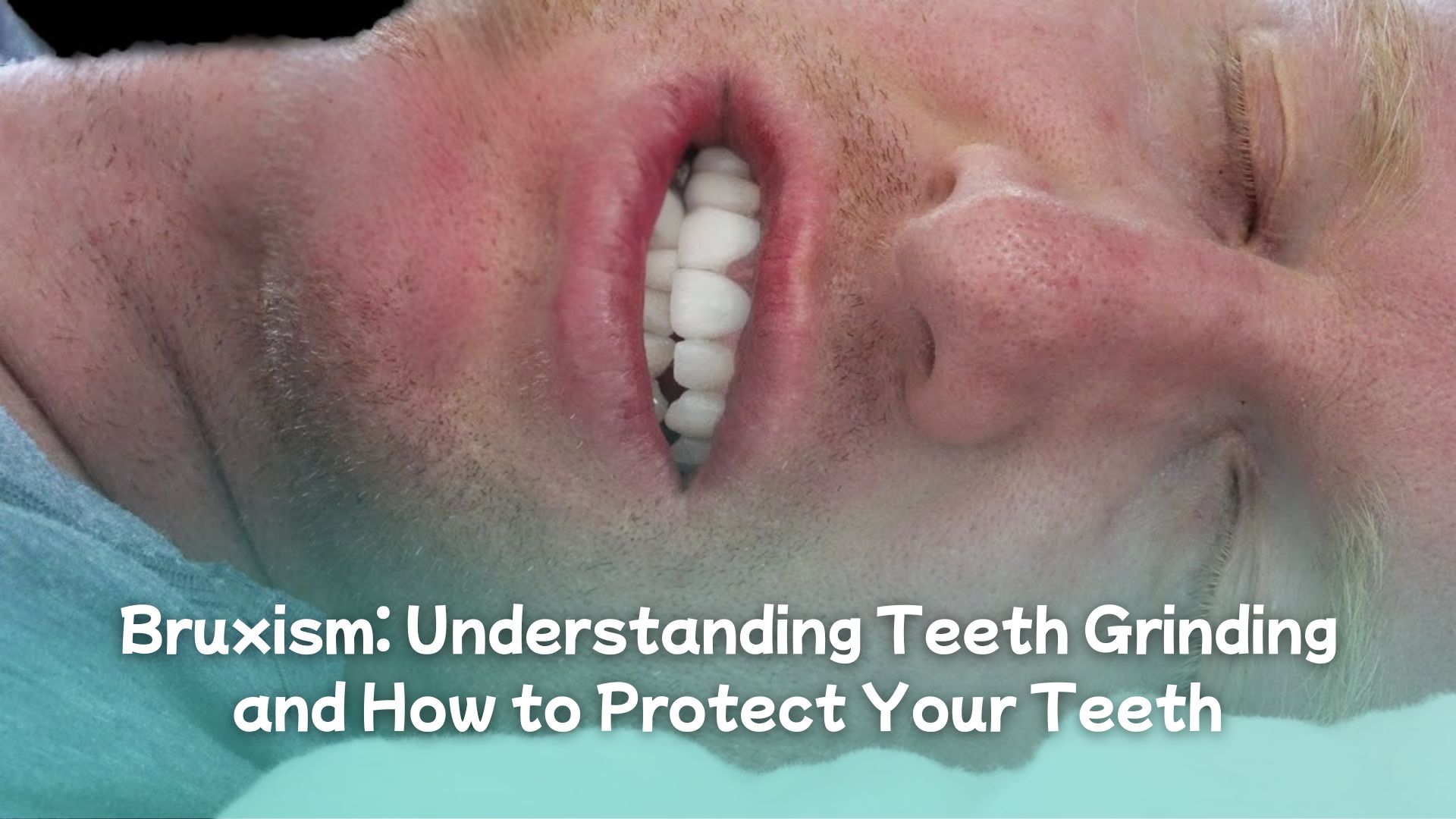Teeth grinding during sleep showing signs of bruxism